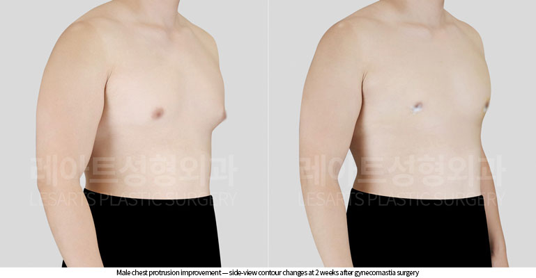 gynecomastia-02-04-260629