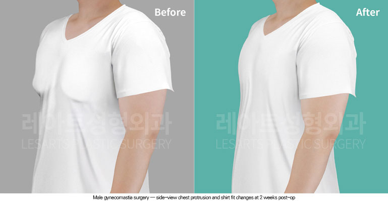 gynecomastia-02-05-260624