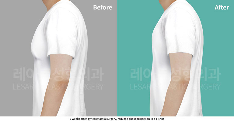 gynecomastia-02-05-260702
