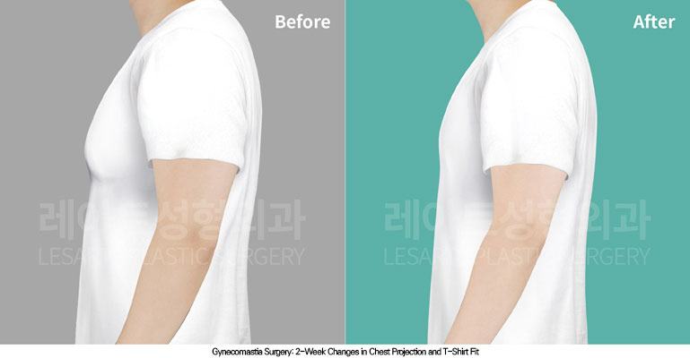 gynecomastia-02-05-260706