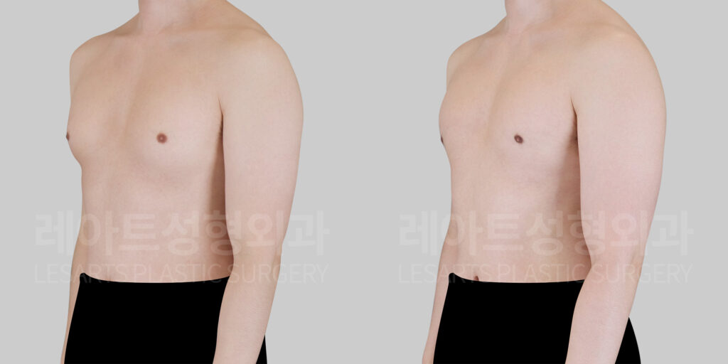 gynecomastia-30834-before-after-lesarts