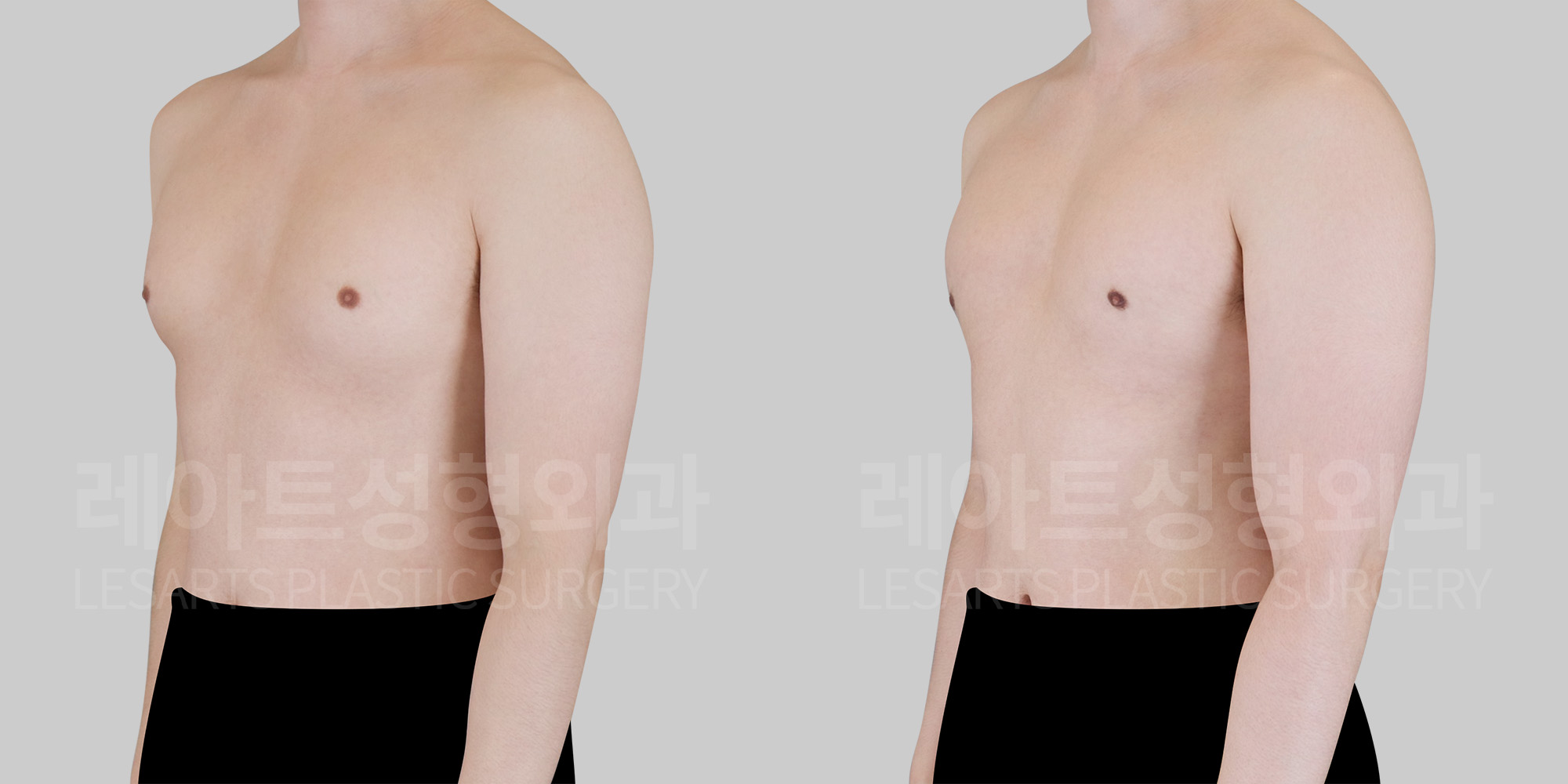 gynecomastia-30834-before-after-lesarts