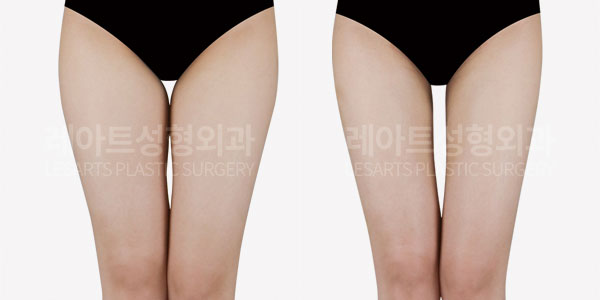lesarts thigh-liposuction before after