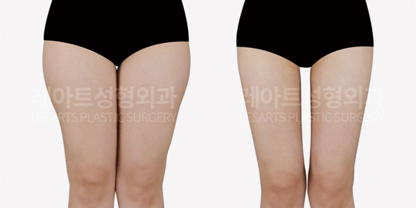 thigh liposuction before and after-lesarts plastic surgery
