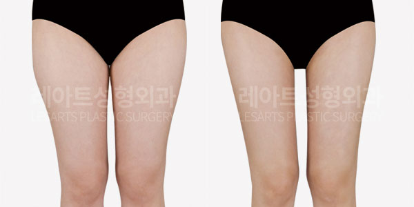 thigh liposuction before and after-lesarts plastic surgery