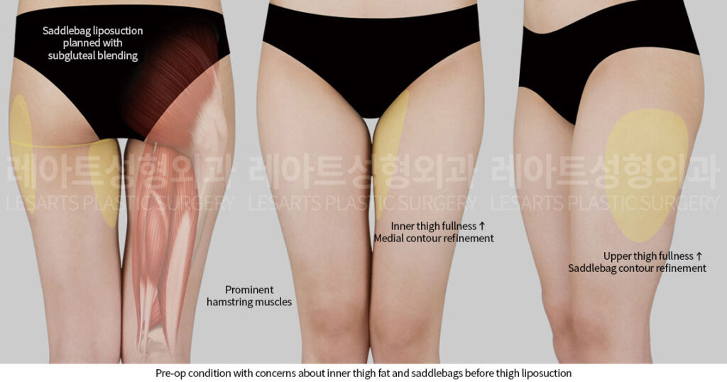 lesarts thigh-liposuction before plan