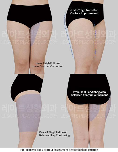 thigh-liposuction-02-01-260701