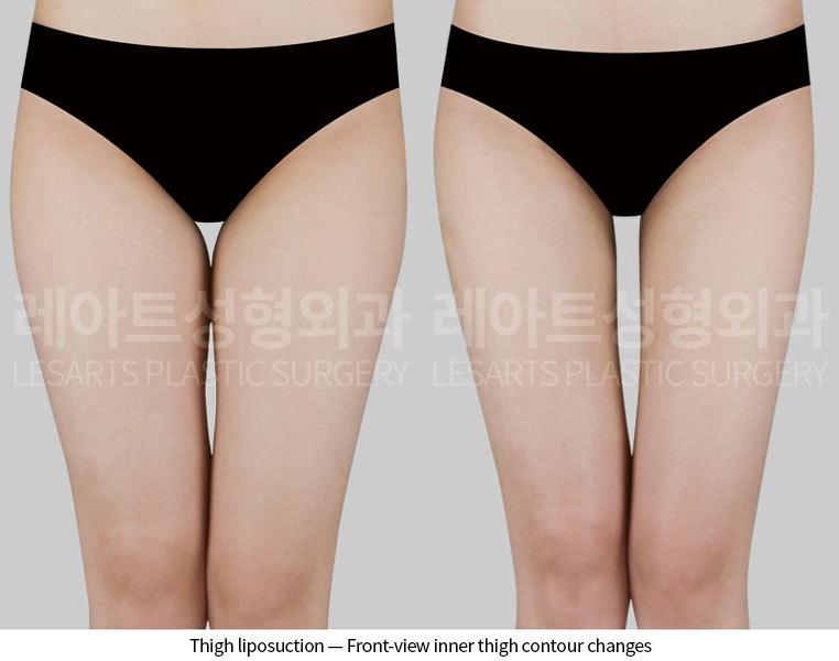lesarts thigh-liposuction before after-front-260629