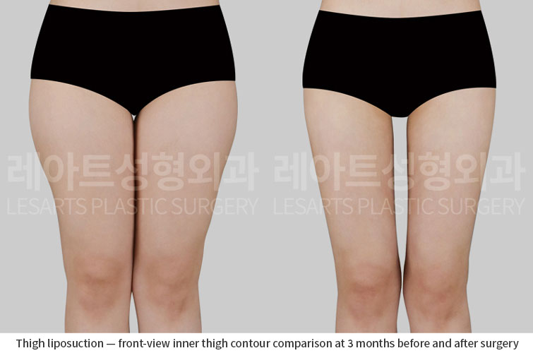 thigh-liposuction-02-02-260701