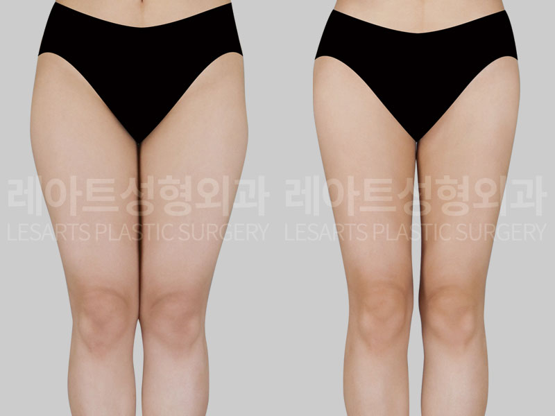thigh-liposuction-02-02-260714