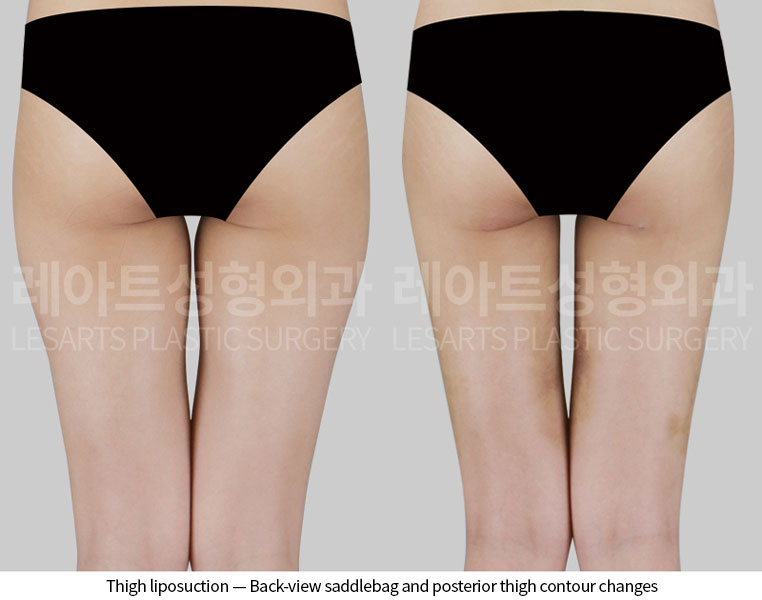 lesarts thigh-liposuction before after-back-260629