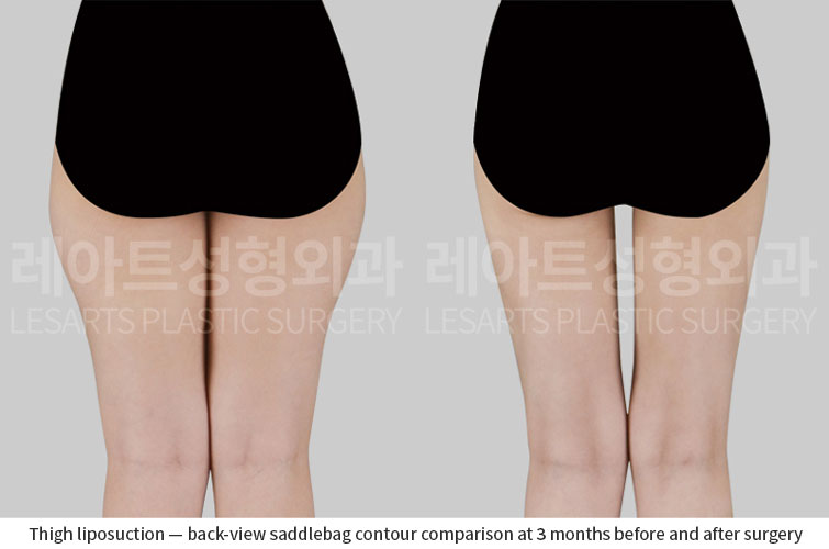 thigh-liposuction-02-03-260701