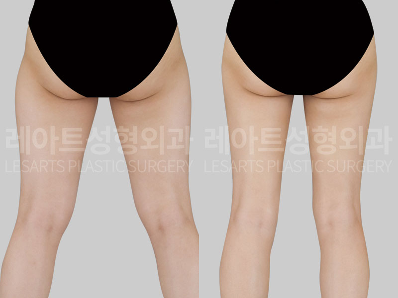 thigh-liposuction-02-03-260714