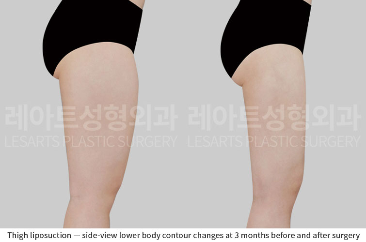 thigh-liposuction-02-04-260701
