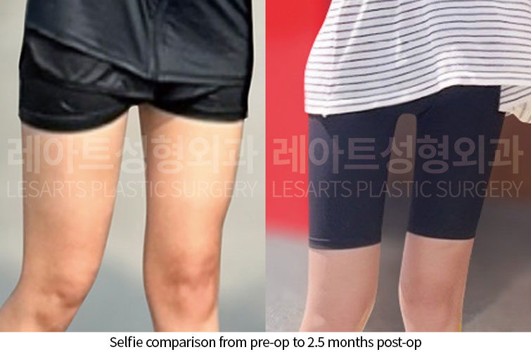 lesarts thigh-liposuction selfie compraison-260629