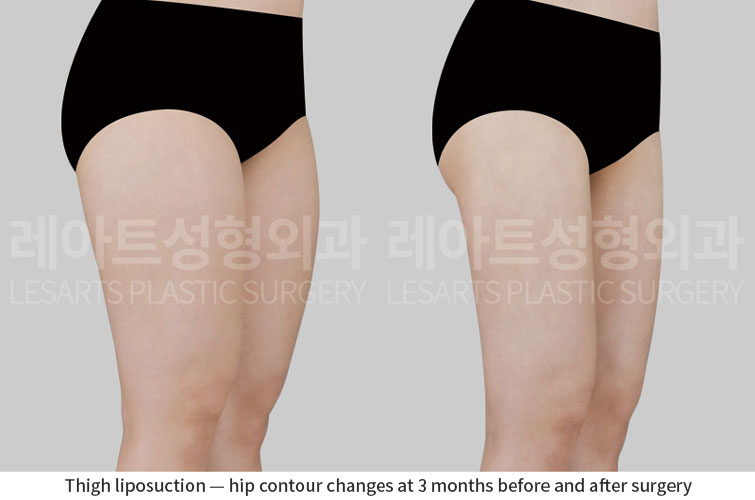thigh-liposuction-02-05-260701