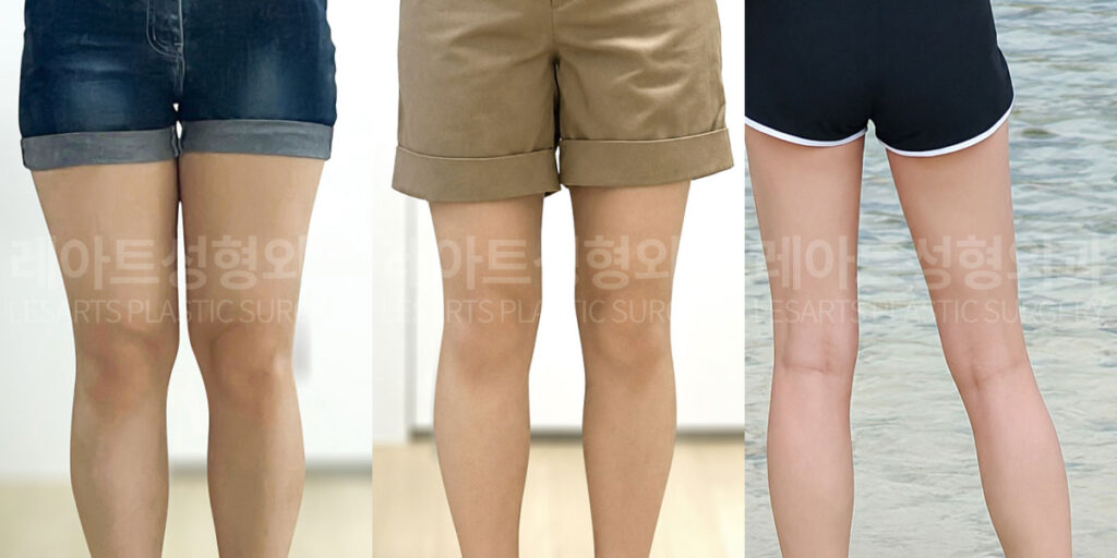 thigh-liposuction-02-05-260714