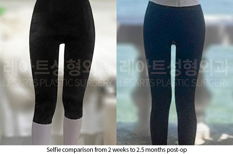 lesarts thigh-liposuction before after selfie-260629
