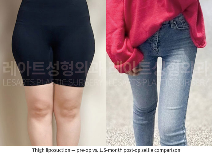 thigh-liposuction-02-06-260701