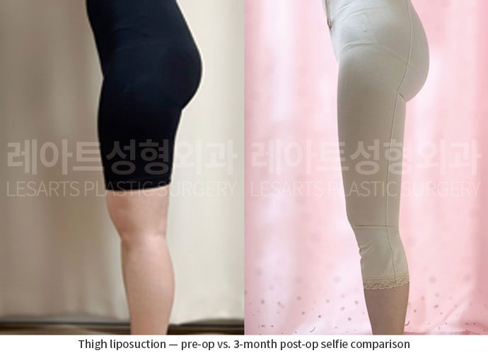 thigh-liposuction-02-07-260701