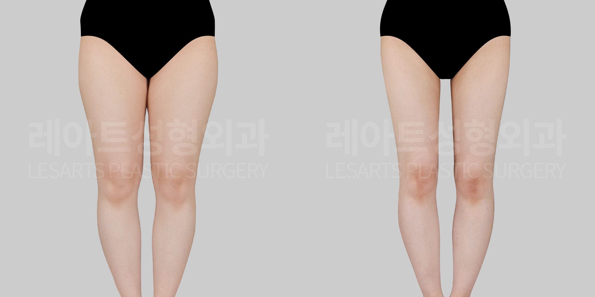 thigh-liposuction-before-after-front