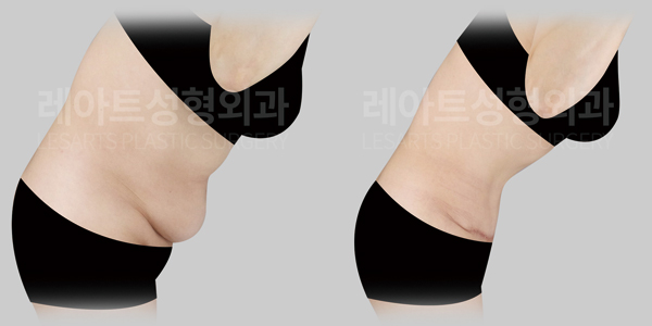 tummy tuck before and after - lesarts plastic surgery