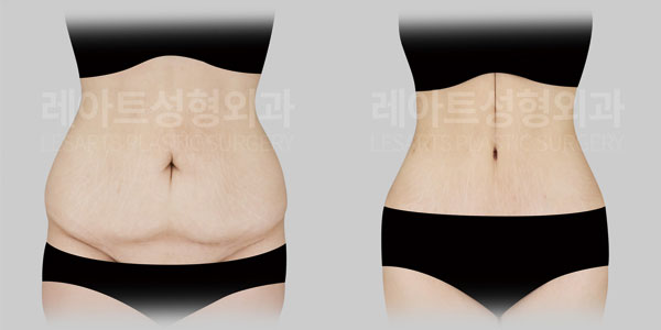 tummy tuck before and after - lesarts plastic surgery