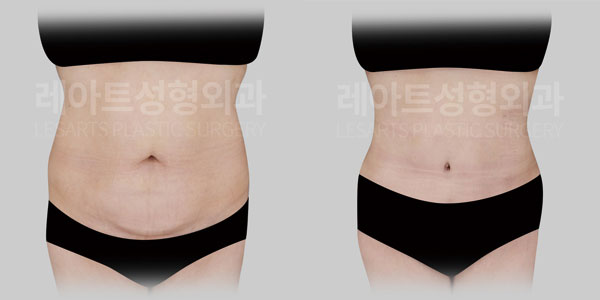 tummy tuck before and after - lesarts plastic surgery