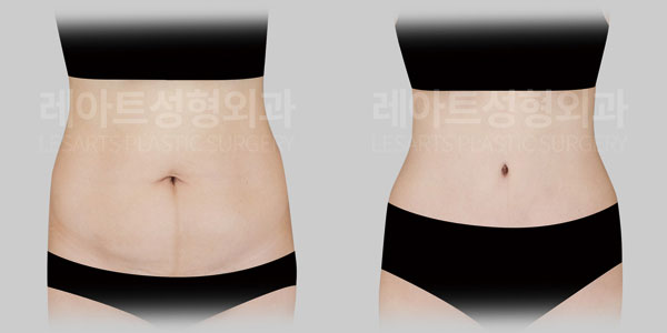 tummy tuck before and after - lesarts plastic surgery