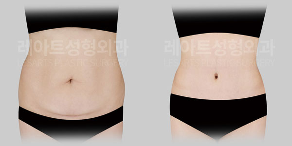 tummy tuck before and after - lesarts plastic surgery