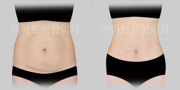 tummy tuck before and after - lesarts plastic surgery