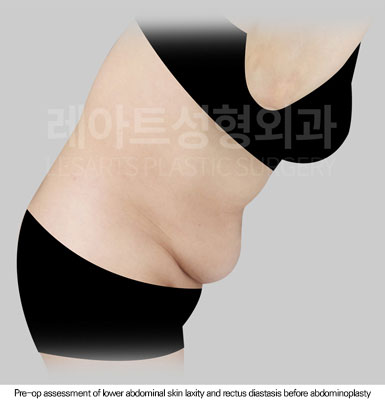 tummy-tuck-02-01-260625