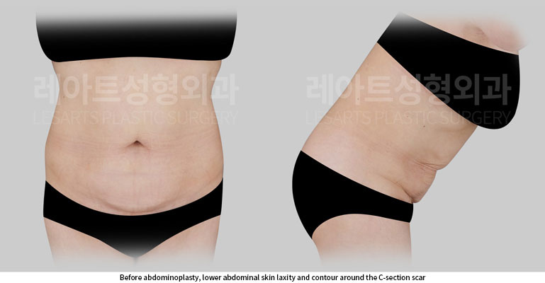 tummy-tuck-02-01-260702