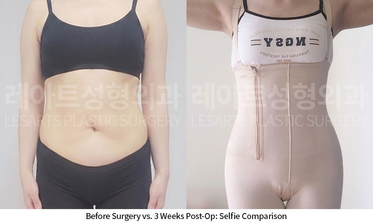 tummy-tuck-02-01-260709