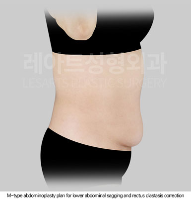 tummy-tuck-02-02-260625