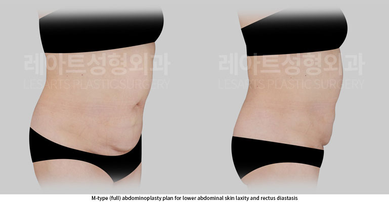 tummy-tuck-02-02-260702