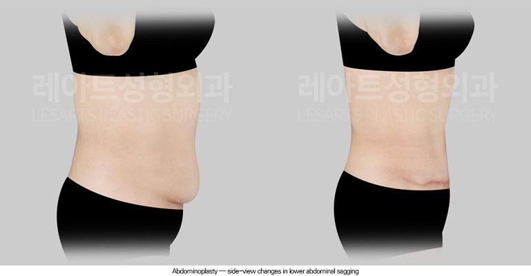 tummy-tuck-02-03-260625