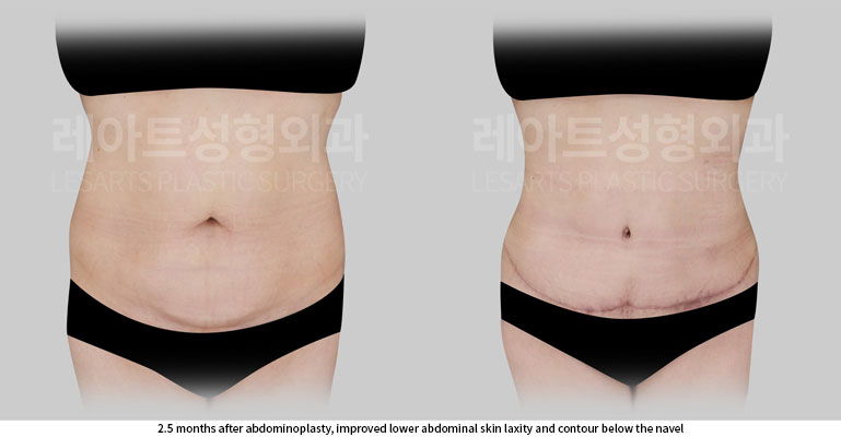 tummy-tuck-02-03-260702