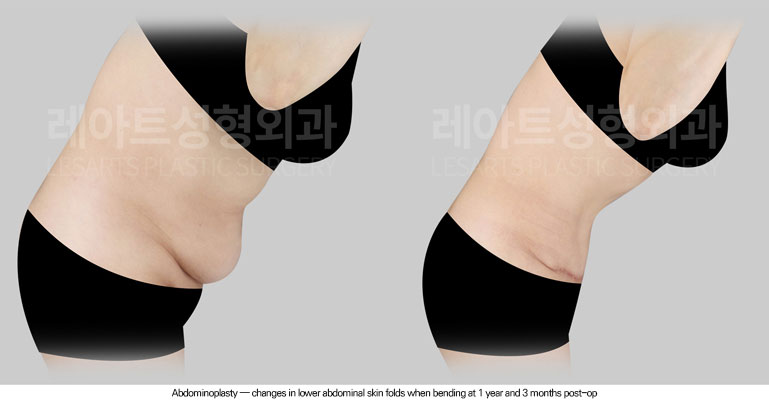 tummy-tuck-02-04-260625