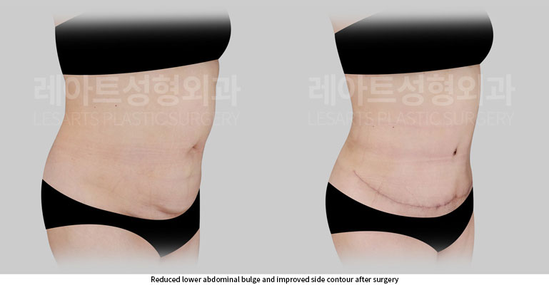tummy-tuck-02-04-260702