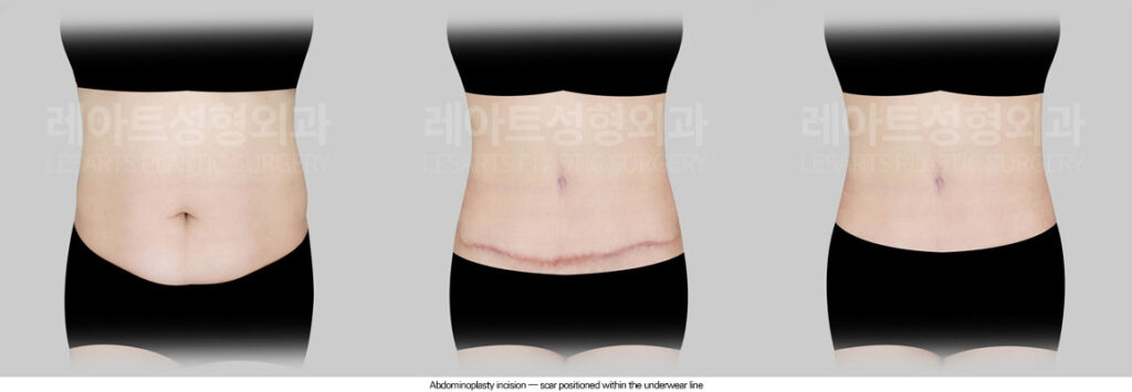 tummy-tuck-02-05-260625