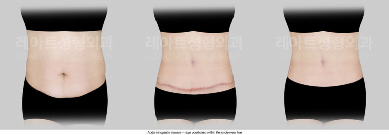 tummy-tuck-02-05-260625