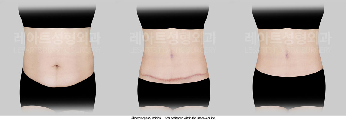 tummy-tuck-02-05-260625