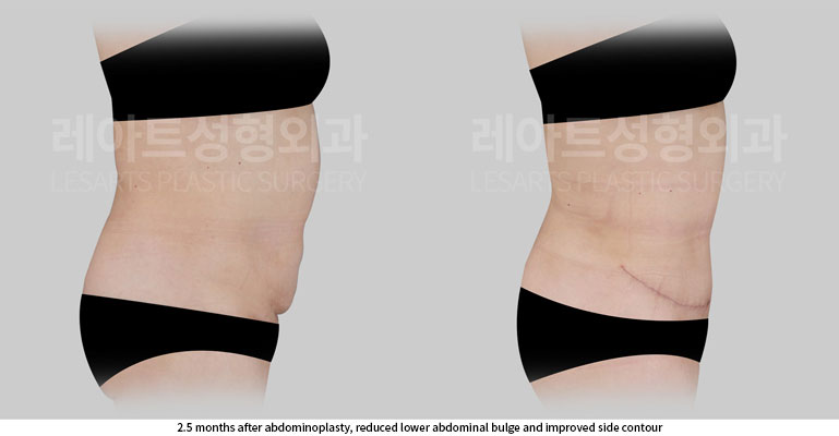 tummy-tuck-02-05-260702