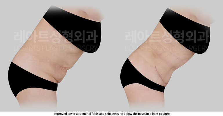 tummy-tuck-02-06-260702