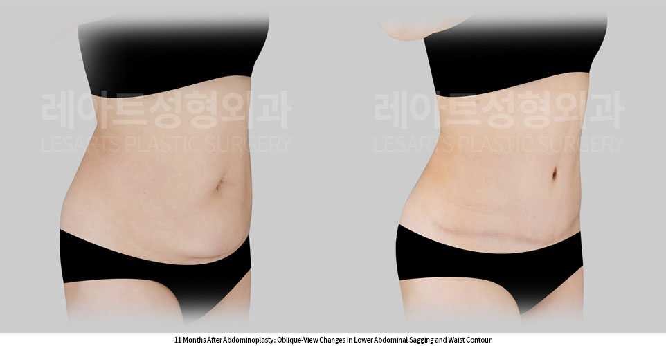 tummy-tuck-02-06-260709