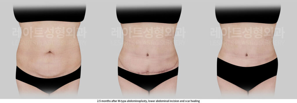 tummy-tuck-02-07-260702