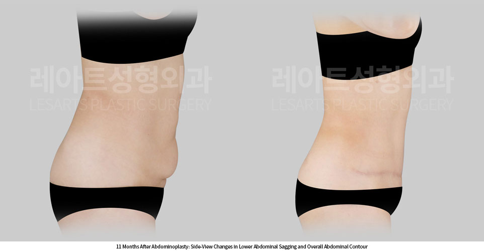 tummy-tuck-02-07-260709