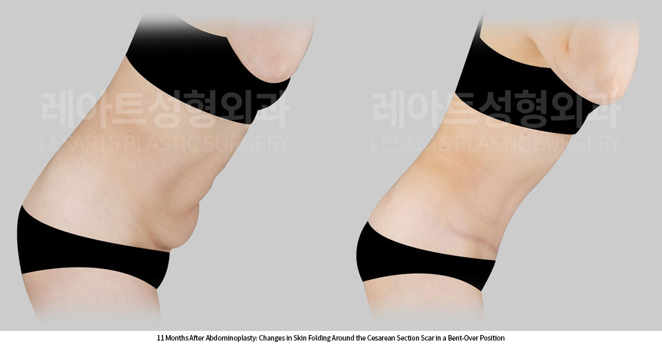 tummy-tuck-02-08-260709