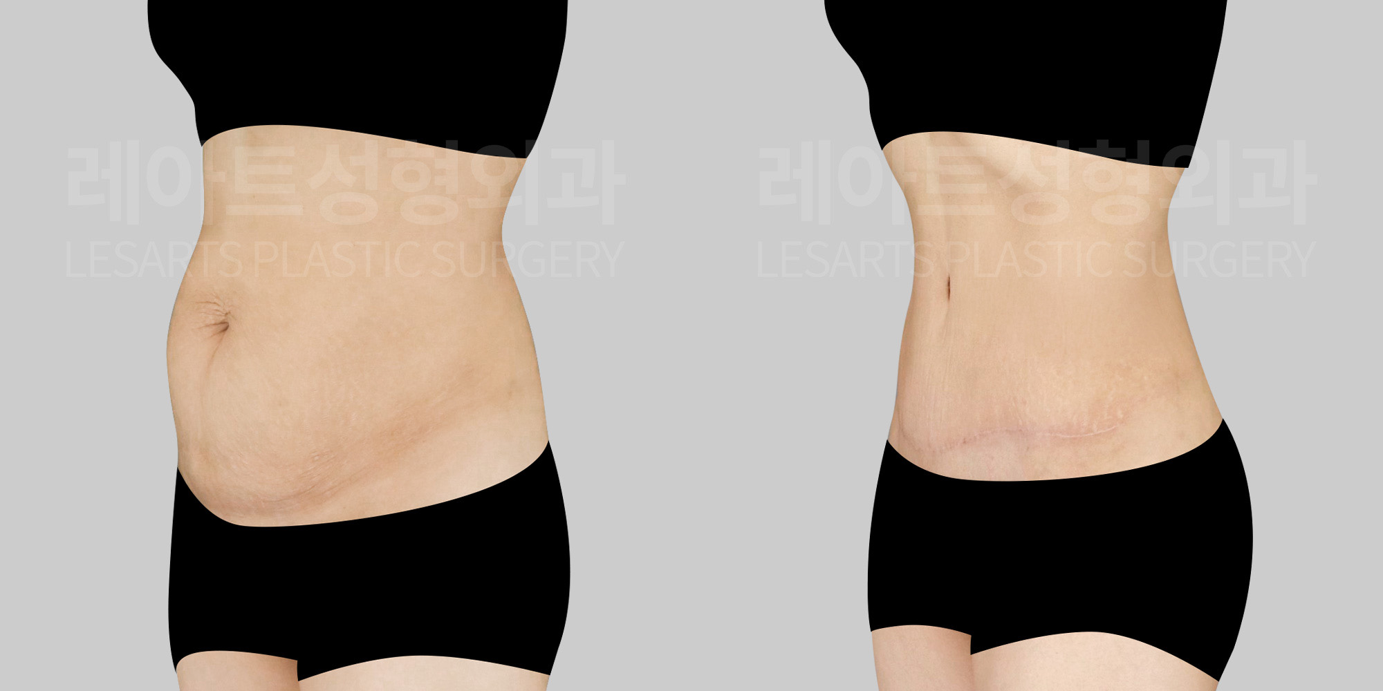 tummy-tuck--before-after-lesarts